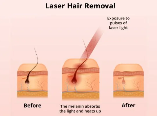 What Happens During the Standard Laser Hair Removal Treatmentin in Hyderabad?